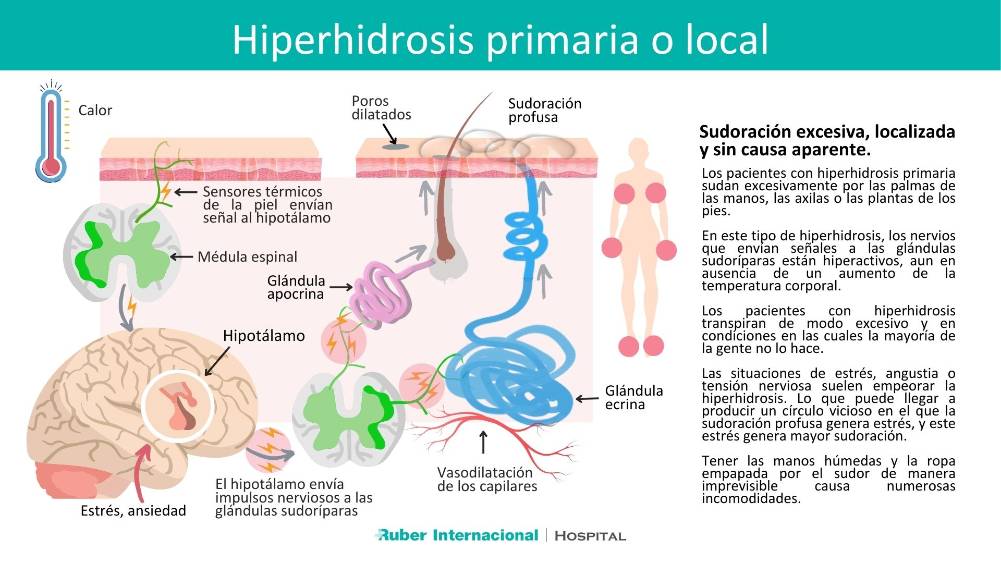 Hiperhidrosis Un Trastorno De La Sudoración Que Afecta Aproximadamente Al 3 De La Población 